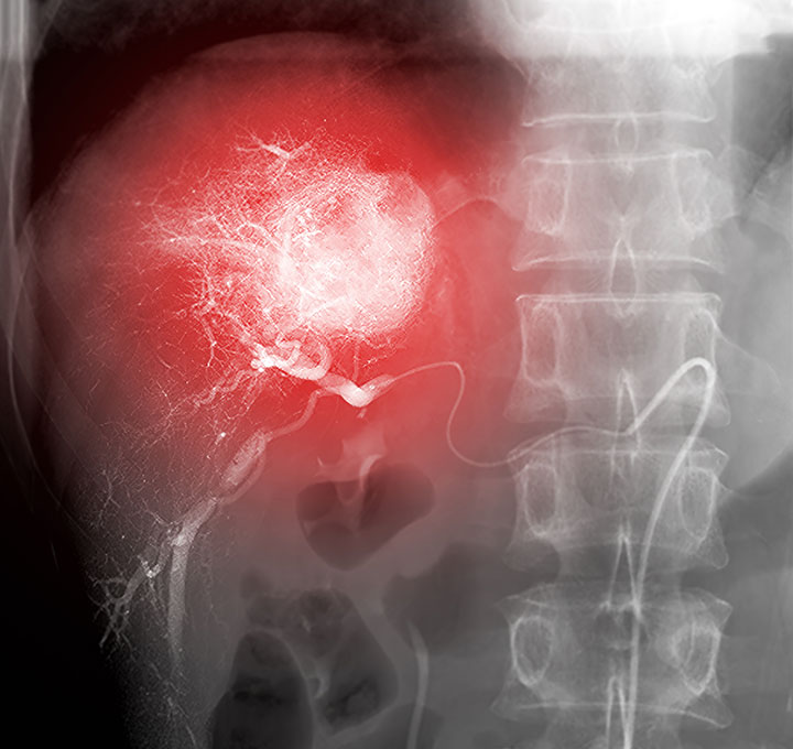 Transarterial Chemoembolization