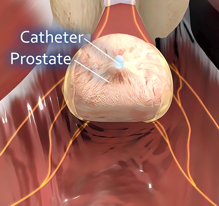 Prostate